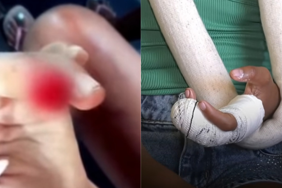 Menina é atacada por cadela e perde parte do dedo em Olinda