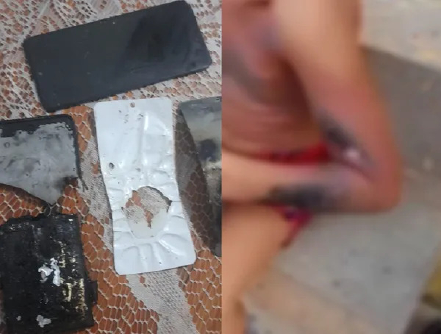 Celular explode enquanto carregava e fere criança no Recife