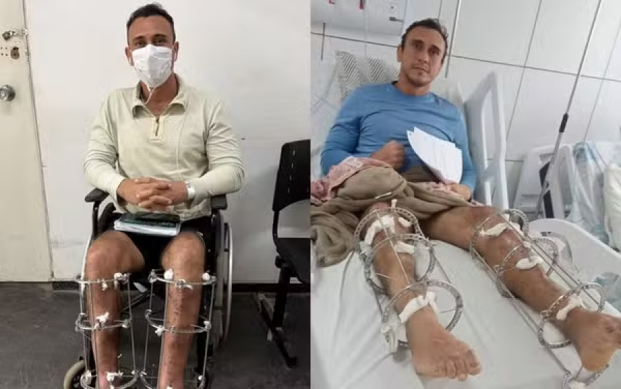 Paciente encontra larvas em ferida enquanto aguarda cirurgia no HR
